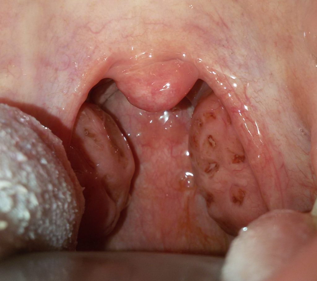 Hypertrophic tonsil, cryptic, of adult patient suffering from recurrent acute tonsillitis
