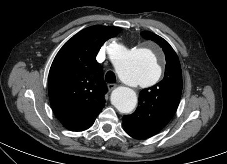 Voluminoso aneurisma dell arco aortico diagnosticato in seguito a comparsa di disfonia per paralisi ricorrenziale sinistra