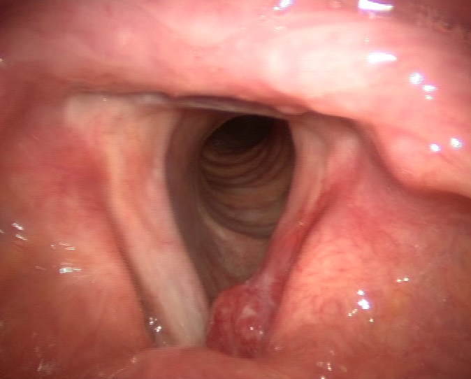 Carcinoma squamocellulare tel terzo anteriore e medio della corda vocale sinistra