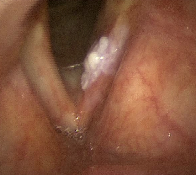 Leukoplakia of the middle third of the vocal chord left