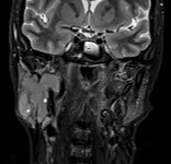 Immagine coronale RMN di pz affetta da s di Sjogren con importante tumefazione della gh parotide destra