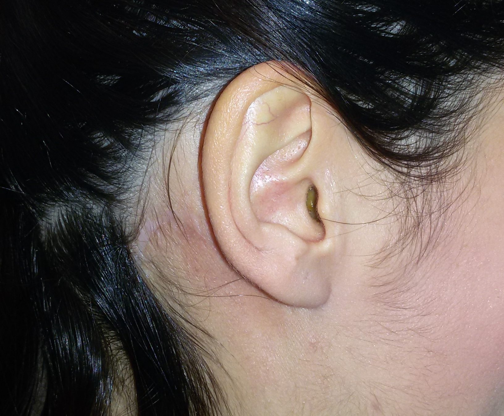 耳下腺彫刻結果
