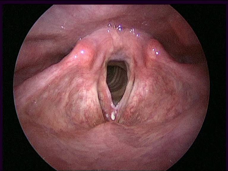 Leucoplasia de cuerdas vocales del medio derecho de terceros y frente y la parte izquierda de la cuerda vocal. La examinación histológica: Carcinoma de células escamosas
