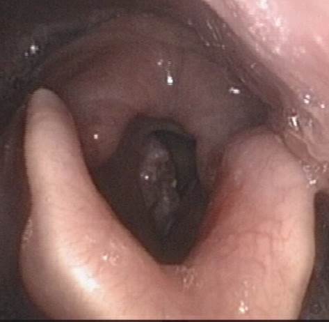 Carcinoma de la cuerda vocal derecha