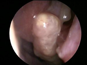 inverted papilloma nasal tratamentul tumorilor cu paraziți