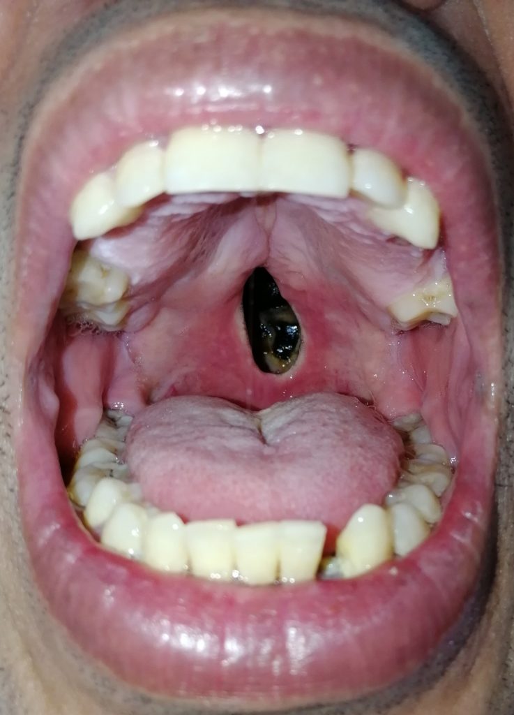 Dommages de cocaïne à son nez et le visage | Dr Francis Pilolli