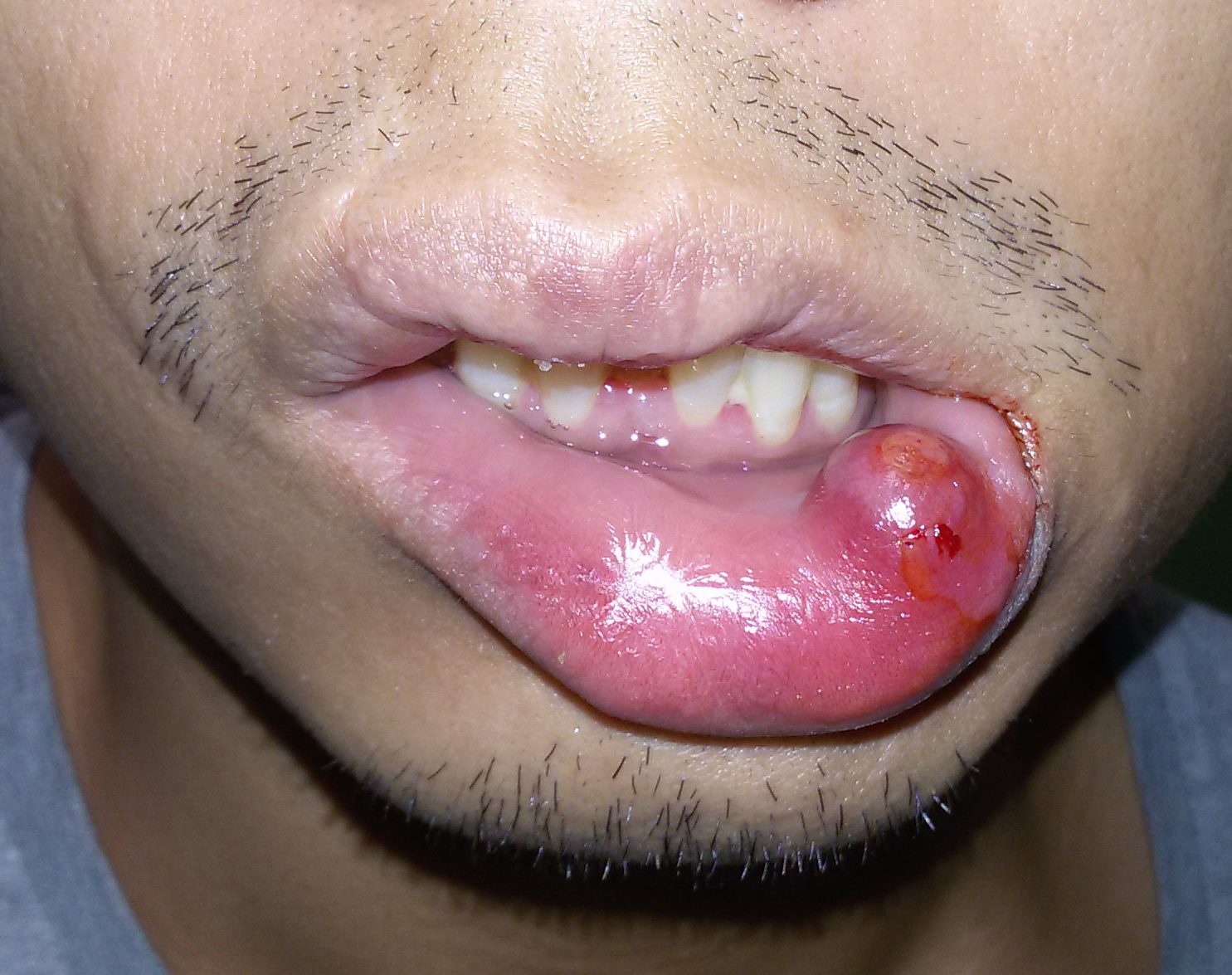 Le cisti da ritenzione delle ghiandole salivari minori (mucocele